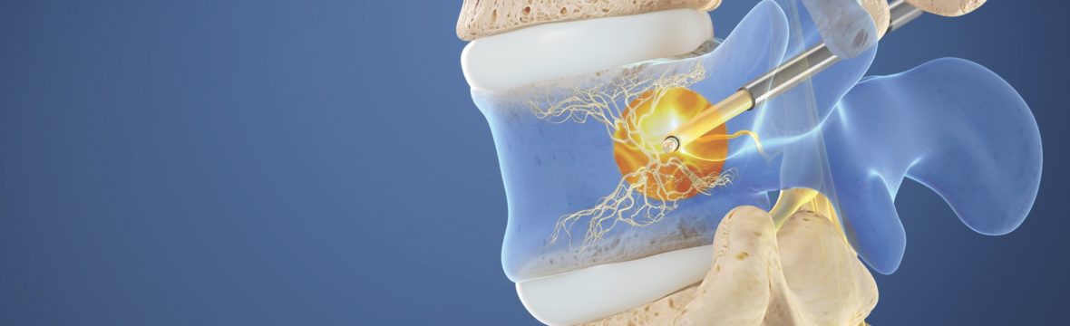 The Cause Of Your Chronic Lower Back Pain - Vertebrogenic Pain