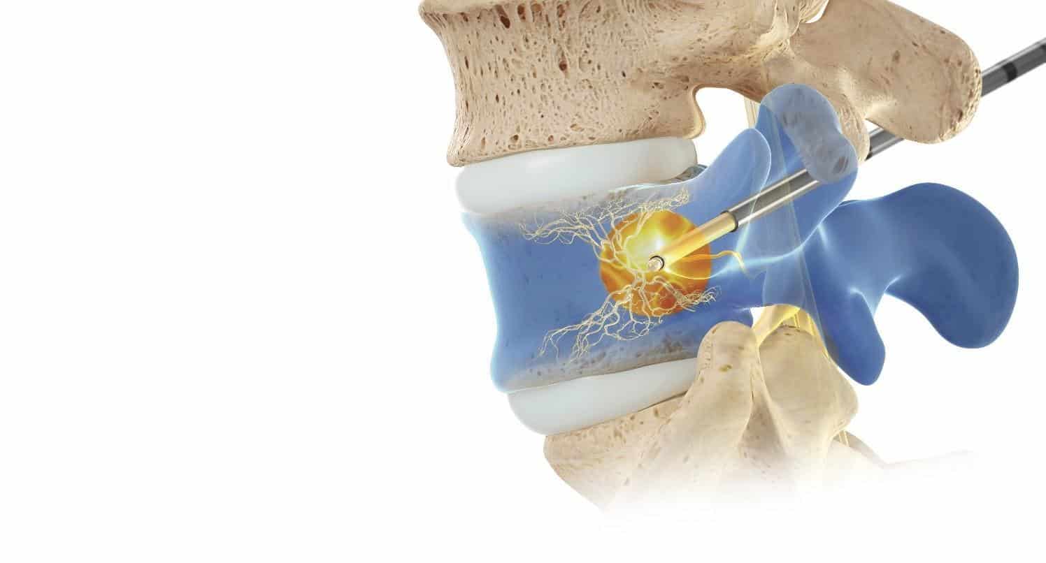 Intracept Procedure - Treats Low Back Pain